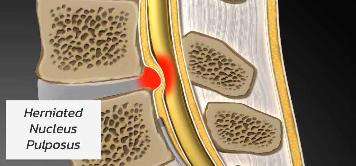 herniated nucleus pulposus causing back pain.jpg